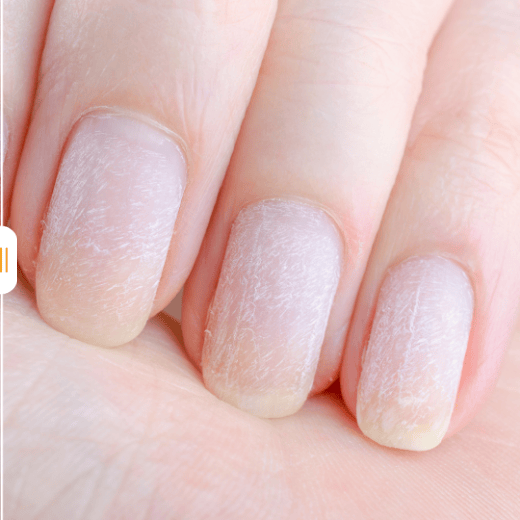 avant apres soin miracle sos ongles fragiles